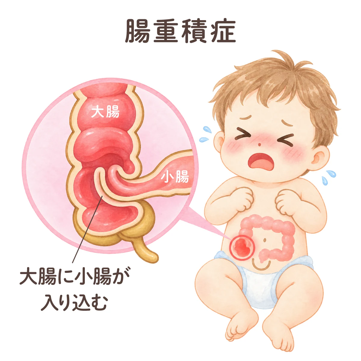 腸重積症の仕組みを示した図。お腹を痛がって泣いている乳児と、その大腸の一部を拡大した図。拡大図では、小腸が大腸の中へ入り込んでいる様子が示されている。