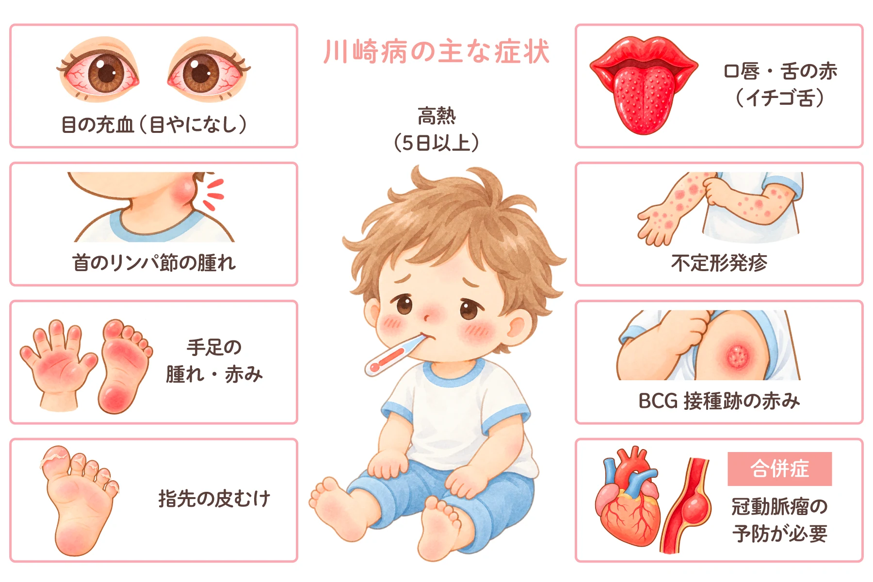 川崎病の主な症状のイメージ図。中央に高熱（5日以上）の子ども。周囲に、目の充血（目やになし）、首のリンパ節の腫れ、手足の腫れ・赤み、指先の皮むけ、口唇・舌の赤み（イチゴ舌）、不定形発疹、BCG接種跡の赤み、そして合併症として冠動脈瘤の予防が必要であることが示されている。