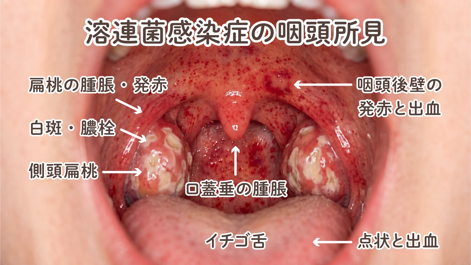 溶連菌感染症の咽頭所見。扁桃の腫脹と発赤、白斑・膿栓、口蓋垂の腫脹、咽頭後壁の発赤と点状出血、いちご舌が見られる。